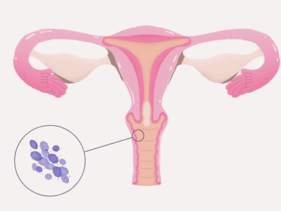 Bacterial Vaginosis