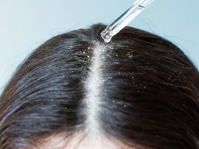 Dandruff Treatment