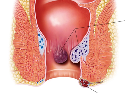 Haemorrhoids Piles Treatment