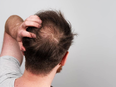 Hair Loss