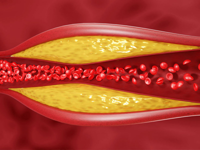 High Cholesterol