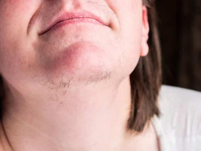Hirsutism Treatment