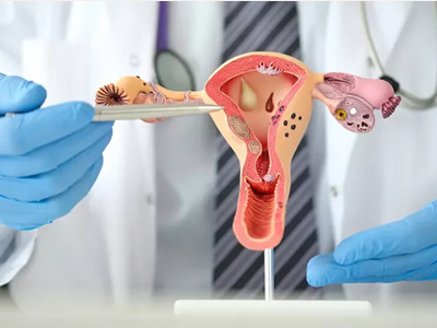 PCOS Infertility